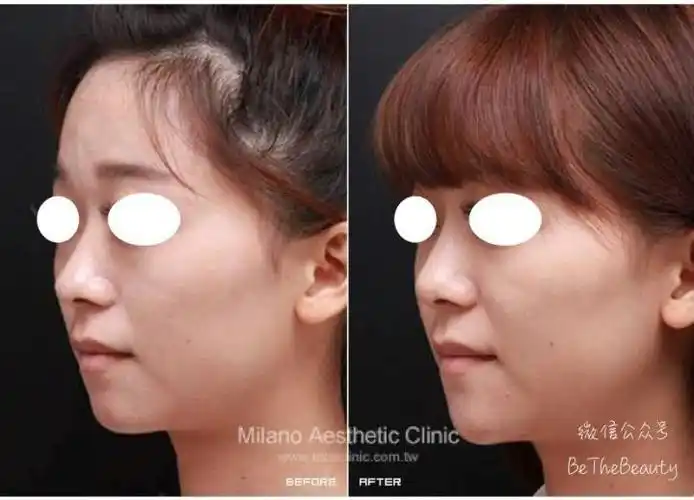 左边是垫山根前,右边是垫山根后正面其实比侧面要更明显:▲左边