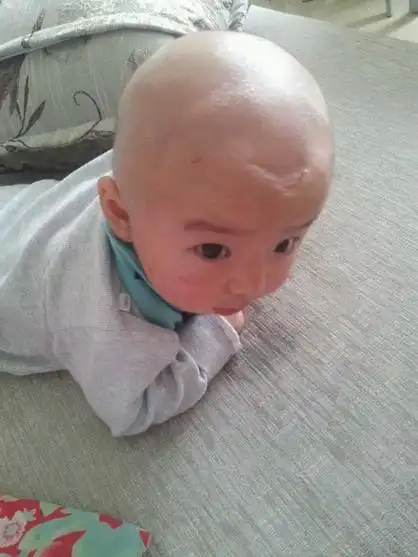 宝宝现在五个月了,额头那里有个小坑,还有囟门那里有个廊,我传图片