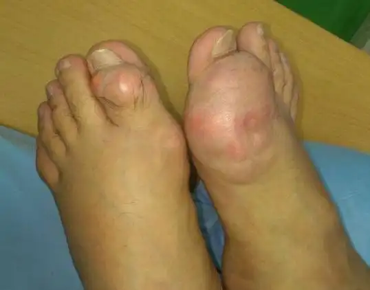 验血结果显示,小明(有高血脂,尿酸也明显偏高,还伴有关节痛等痛风症状