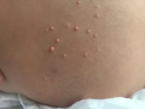 儿童传染性软疣如何治疗