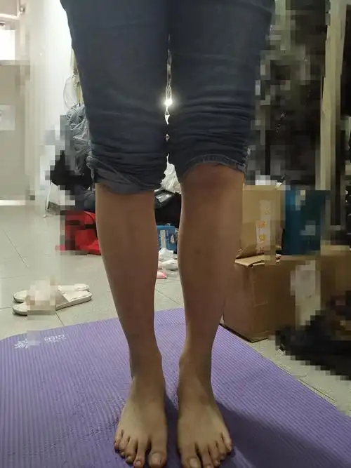 小腿肌肉内翻的福星