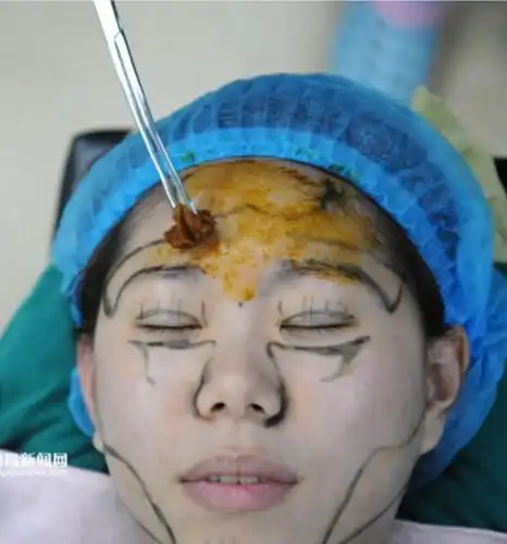 手术室罕见的整容大片25岁青岛女孩直播整容