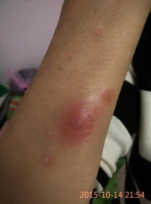 如图,三周前,小手臂上长了个凸起的疙瘩,鼓起的头子破了流了些血,后