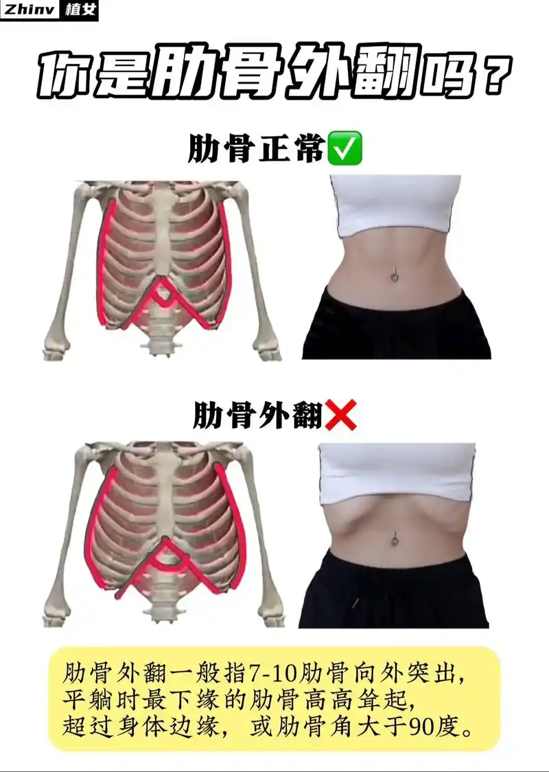 肋骨外翻快改正!肋骨外翻很多姐妹都有!😆点开 - 抖音