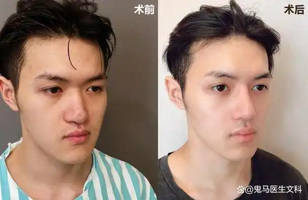 鼻子作为五官之首,对颜值的影响可见一般,可以说是直接决定了面部的