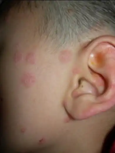 同是牛皮癣,却有老幼之别_寻医问药网皮肤病频道