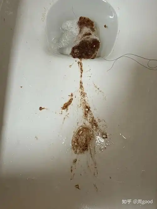 刚刚呕吐出来的,是胃出血? - 知乎