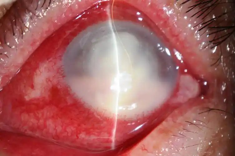 穿透性角膜移植术治疗严重真菌性角膜溃疡4例