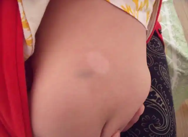 无色素痣 的表现及与白癜风和贫血痣的区别_痣_症状_症状表现 - 好