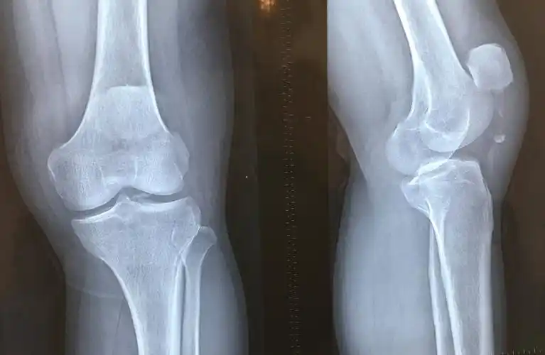 髌骨下极撕脱骨折"鬼脸固定法"_髌骨骨折_治疗方式_康复锻炼 - 好大夫