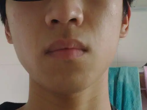 脸上鼻子两边到嘴巴两边有两条凹线,不是普通人的那种,问过人说是肠胃