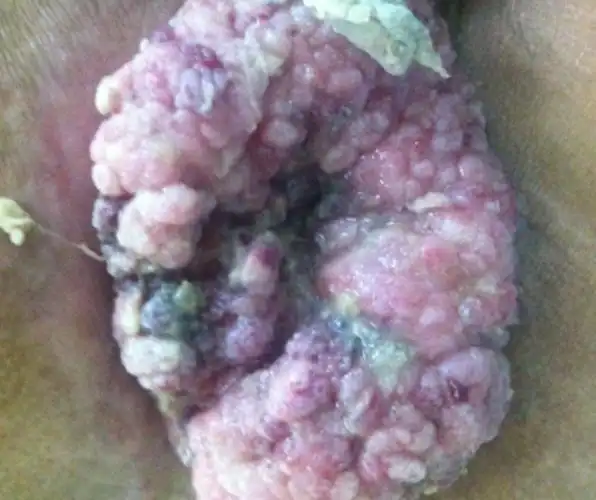 疣扁平疣图片肛门疣病的图片菜花状的肛门疣图片初期肛门疣湿疣图片