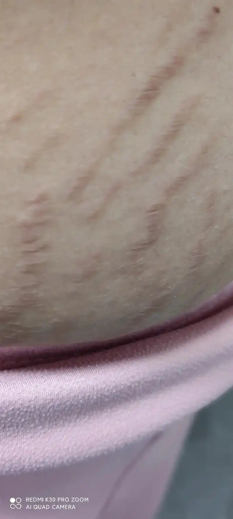 妊娠纹从小腿内测长到大腿,肚子,🐻部,衣服从m码穿到xl码 - 抖音