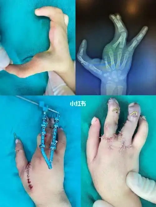 分裂手二期手术术后