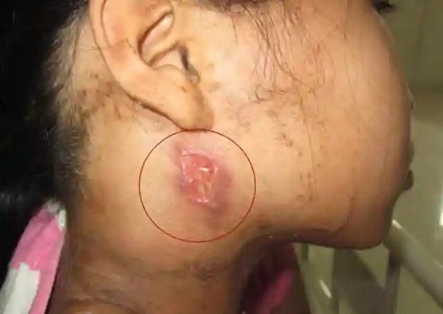 许多患者在初期,发现淋巴结肿大后因为不知到底是什么疾病而盲目医治