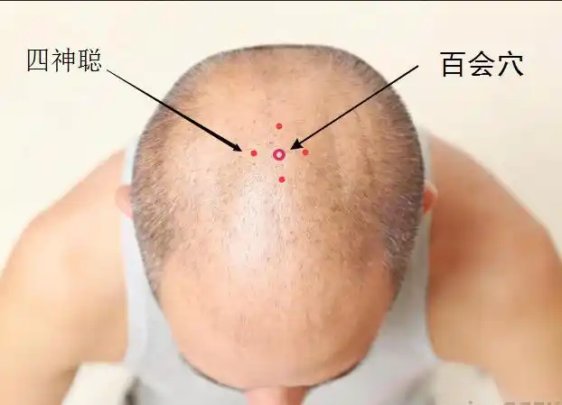 还有一个取百会的办法,就是取两耳尖连线与头顶正中线的交点.