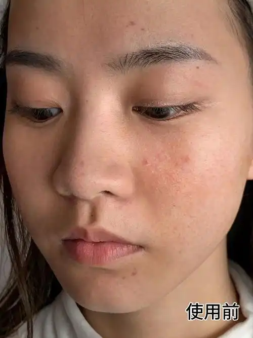 毛孔小了细纹平了,皮肤摸着光溜溜的,好滑好水嫩!