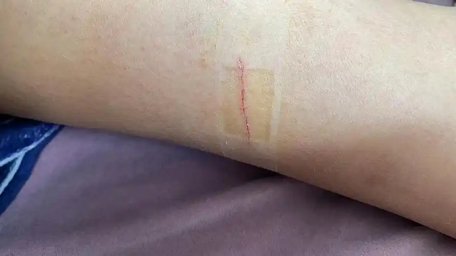 讨论被猫划伤了