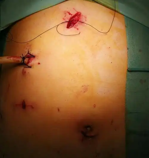 小切口,大作为——中大五院肝胆外科胆石症微创诊疗技术报道