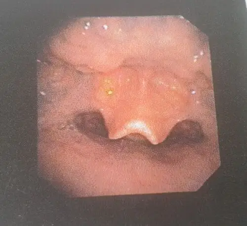 咽后壁淋巴滤泡增生的治疗方法