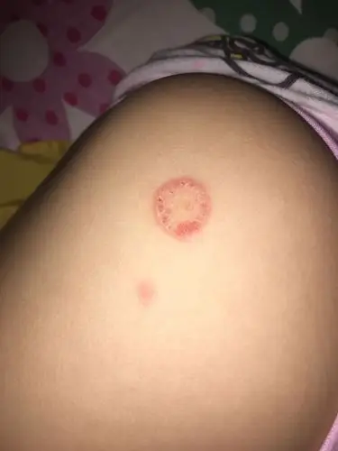 宝宝屁股起了像癣的个红圈圈的