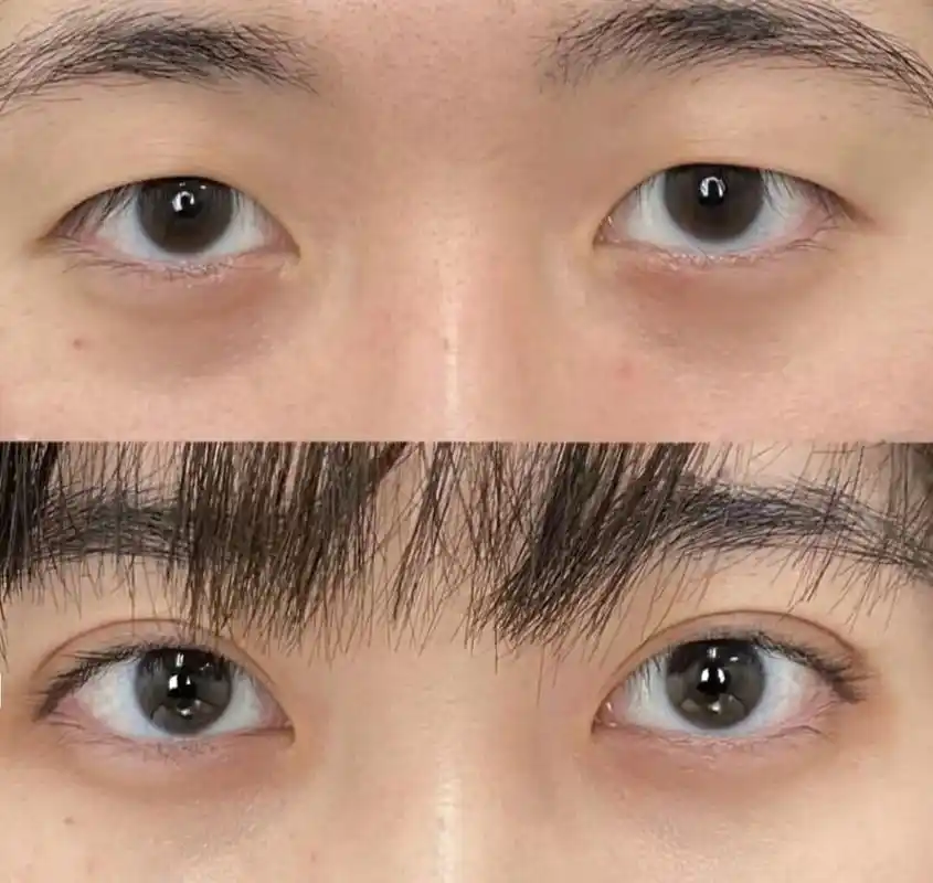 选择大于努力?25岁小姐姐双眼皮术前术后效果图