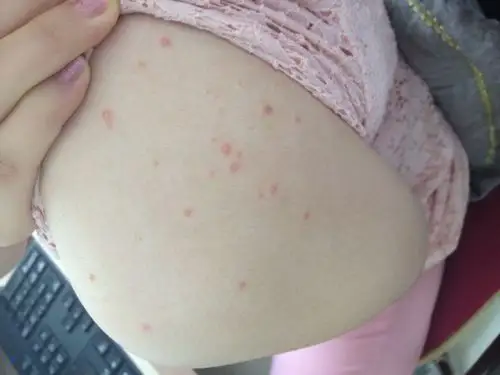 问:背部靠肩的位置长红点点,不疼也不痒,是怎么回事