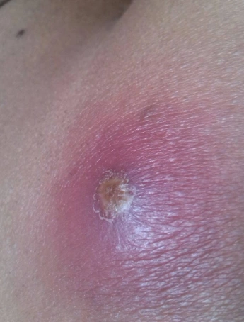 臀部火疖子图片4