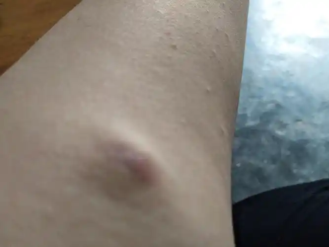 手臂上长了个包,有姐妹知道那是什么吗