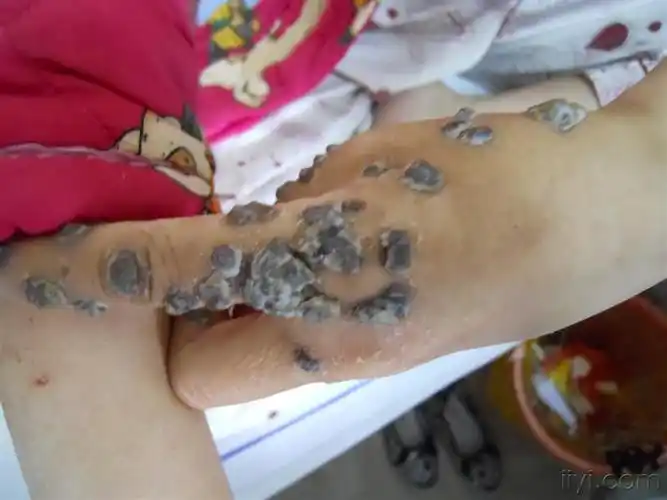 女性,46岁,aids并有青霉菌病,伴左上肢皮疹1月余,明天补上病史及钢