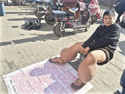 23岁小伙长了双"大象腿" 冬天也不能穿裤子(图)