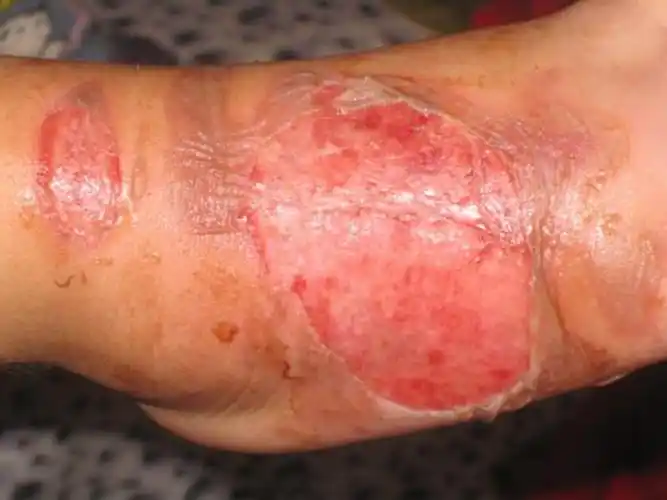 二级烫伤后恢复的图片_有来医生