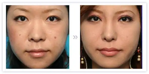 鼻翼缩小前后对比图