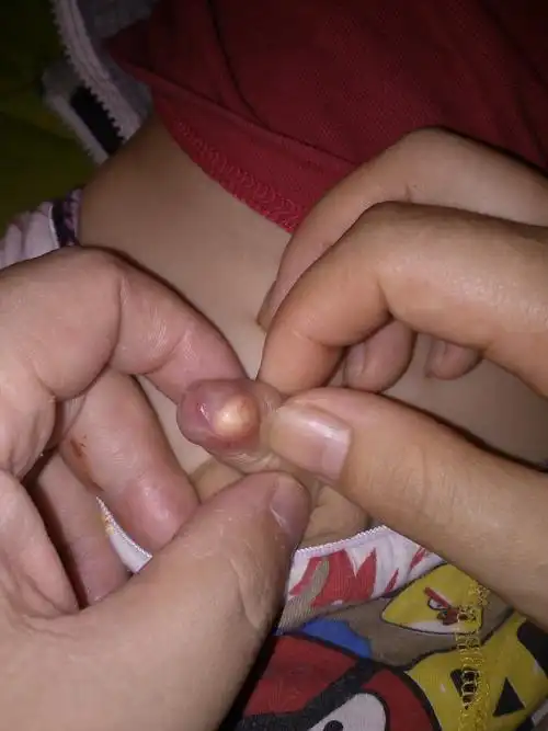 刚刚给宝宝洗澡,发现鸡鸡皮里有个白疙瘩