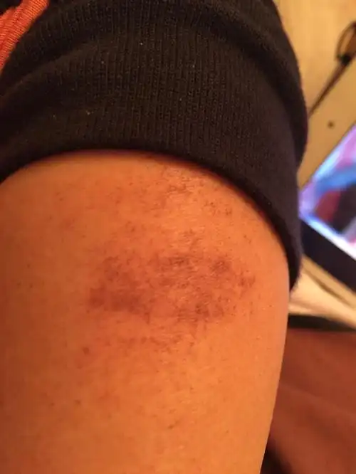 e光脱毛 把皮肤烫伤了, 出现了黑色的一片的小黑点 怎么办 还能掉吗?