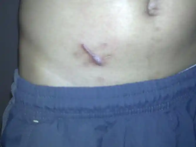 我阑尾炎手术完都一个多月了 到现在刀口好像还没长好呢 哪位好医生