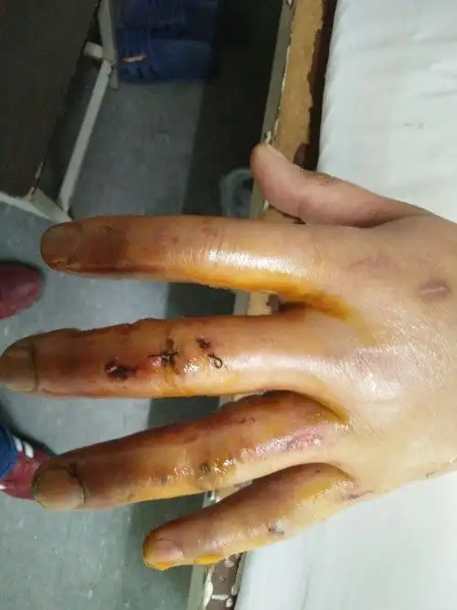 小心干活时手被压面机压到了导致四个手指尖都是粉碎性骨折(不算拇指