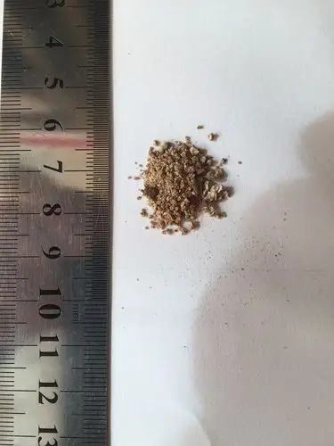 右侧输尿管多发结石体外碎石一次成功!