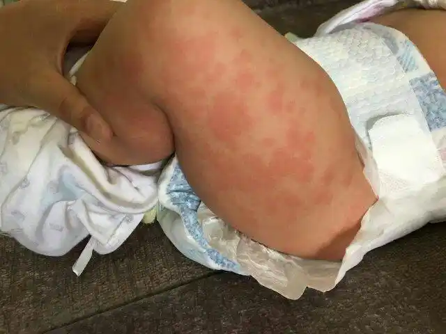 小孩身上长了癍状红疹还感冒和发烧?什么情况?怎么医治?