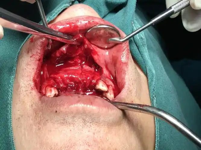 上颌骨囊肿及根尖囊肿摘除及上前牙拔除即刻种植分享 - 好大夫在线