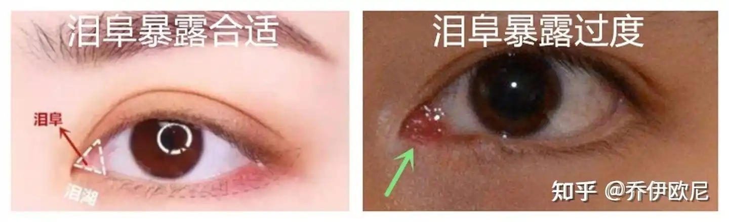 泪阜暴露过度,看起来不舒服————angelababy还是开了眼角,而且两只