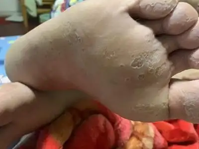 窝状角质松解症脚底脱皮像蜂窝一样图