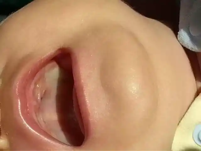 宝宝的口腔上颚两侧正常的应该是什么颜色?