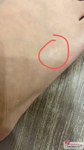 大家帮忙看看我脚踝和脚背上的白斑是不是白癜风?
