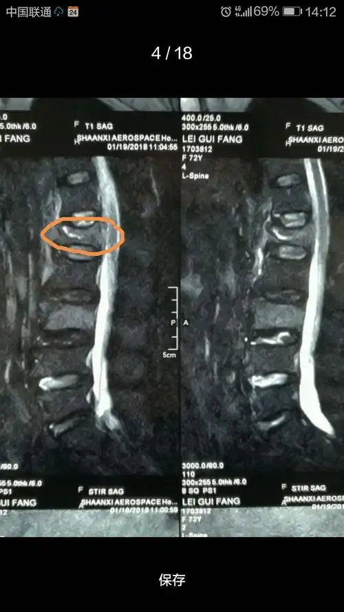 腰1椎体压缩性骨折(3度)