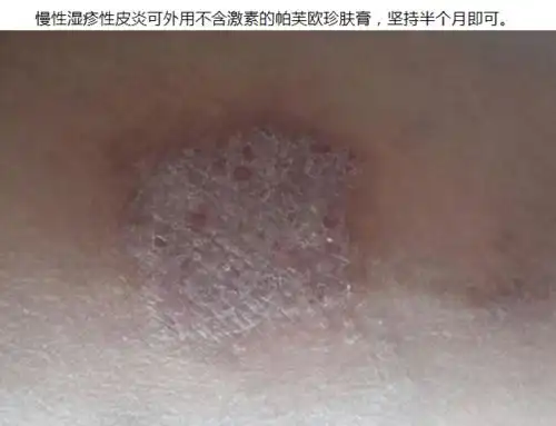 慢性湿疹性皮炎,护理须知5大点