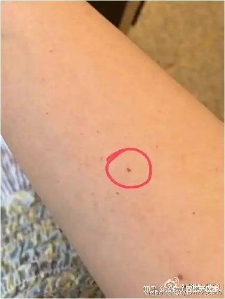 今天讲一讲最常见的一种血管瘤樱桃样血管瘤