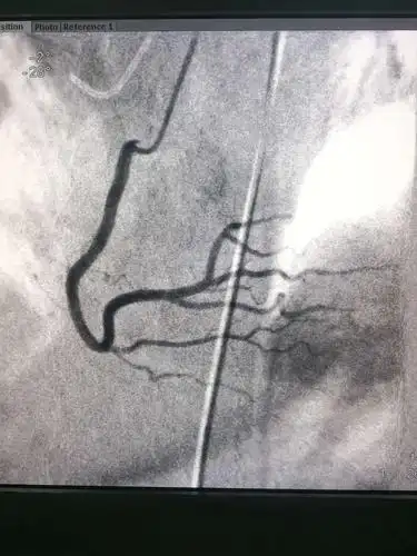 其它 全脑血管造影术 冠脉造影术1例  主动脉弓造影 全脑血管造影