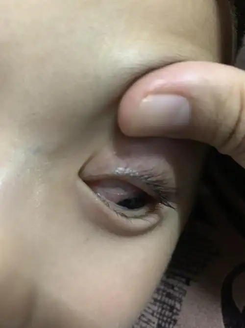 儿子6岁,眼睛发炎到各大医院检查都只是说细菌感染结膜炎,每隔几天就