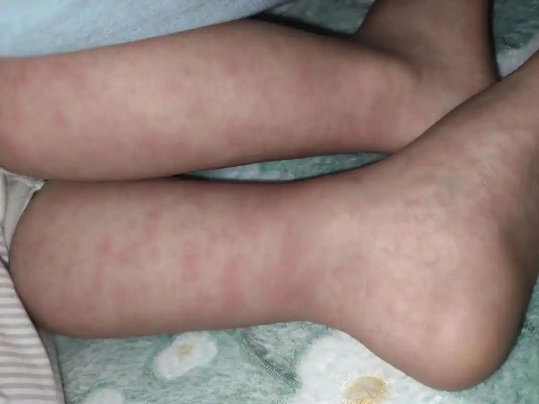 宝宝怎么会突然全身红疹呢?#全身过敏起红疹  早上 - 抖音